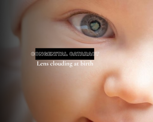 Nuclear Cataract Eye Nuclear Cataract Eye